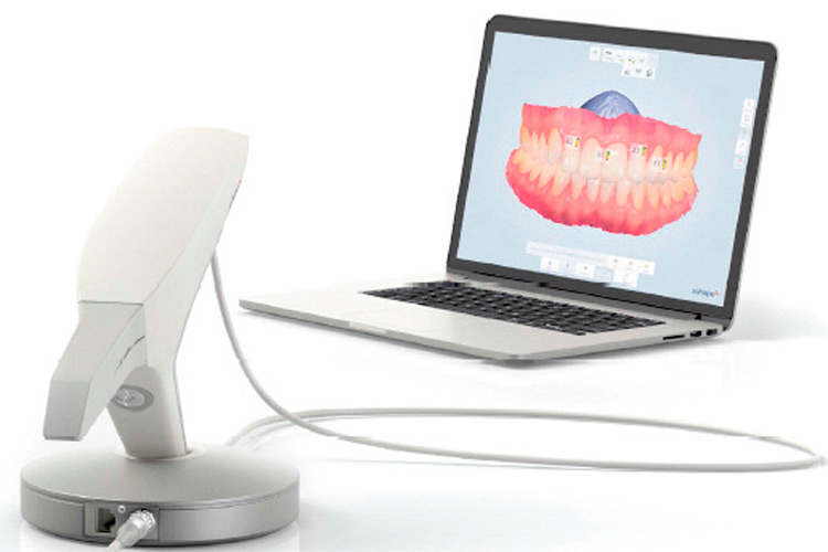 Der Intraoral Scanner ist eine Erleichterung in der Zahnheilkunde.